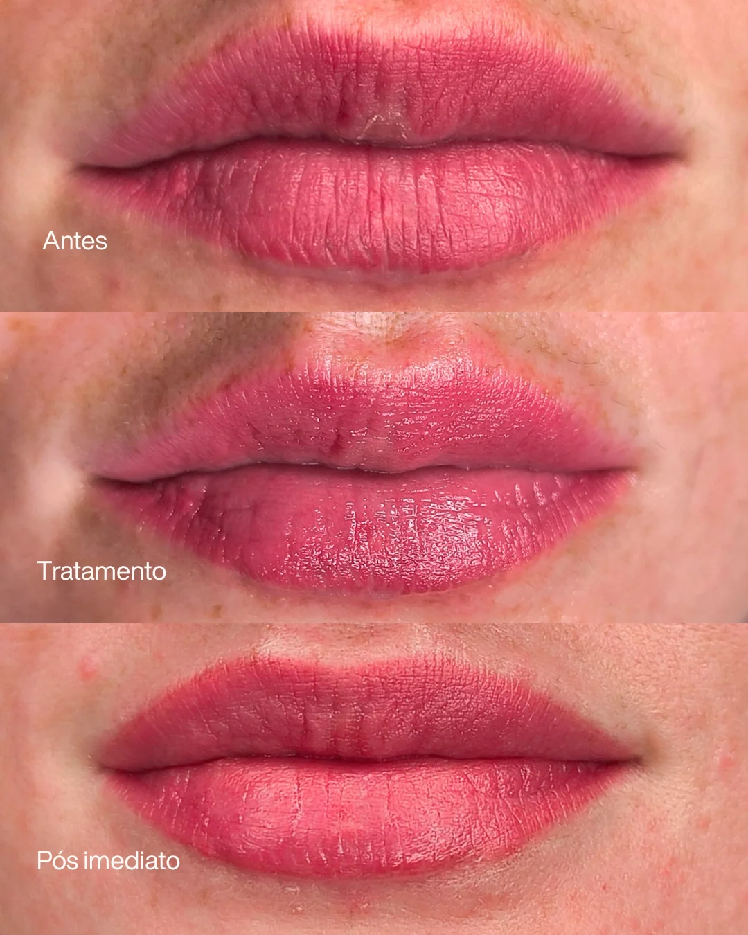Tratamento de cicatriz labial e correção de cor — comparativo. Portfólio de Andréa Angel.
