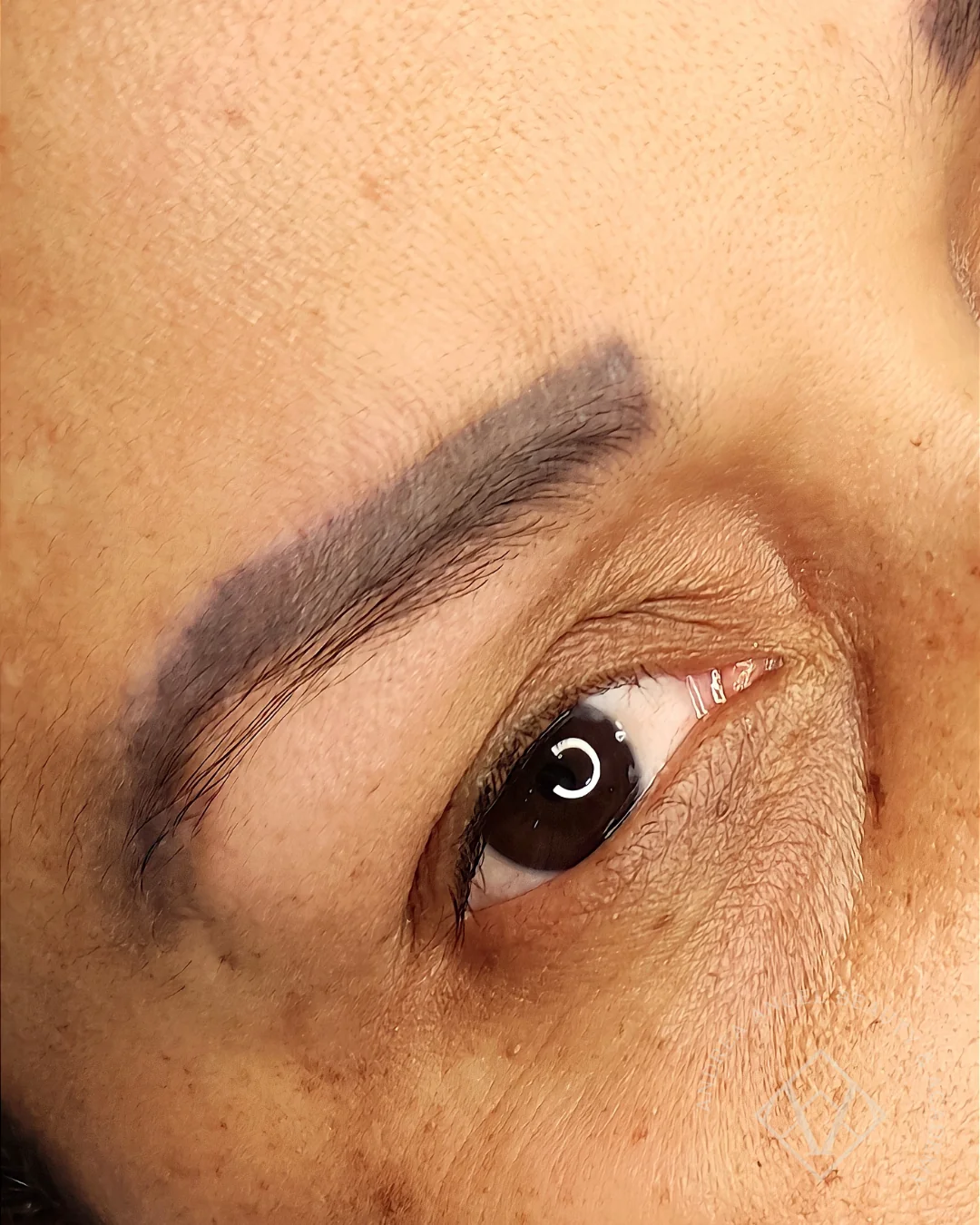 Remoção a laser de micropigmentação. Portfólio de Andréa Angel.